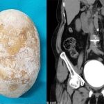 bladder stone