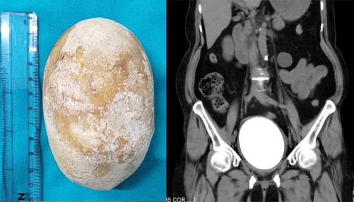 bladder stone