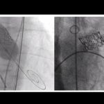 heart valve replacement