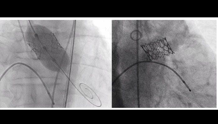 heart valve replacement