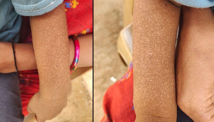 spot disease